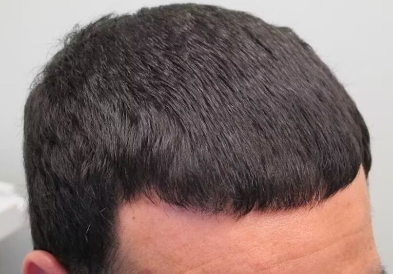 I cured hair loss Verdoxidil