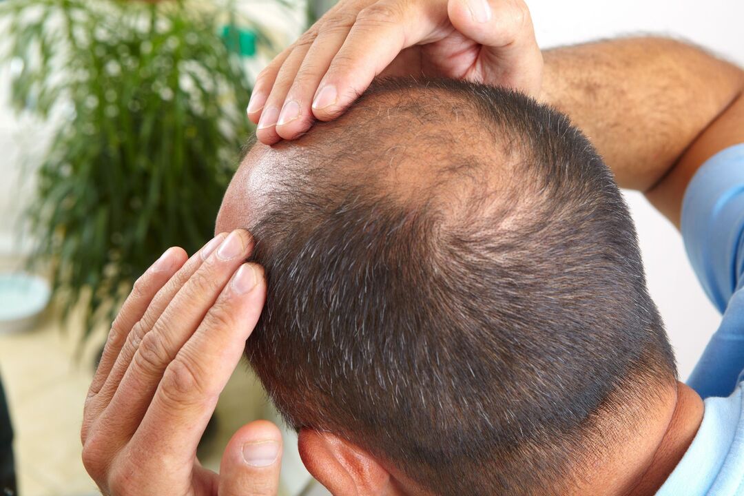 Running the spray zxcvbnmqwort for the treatment of baldness