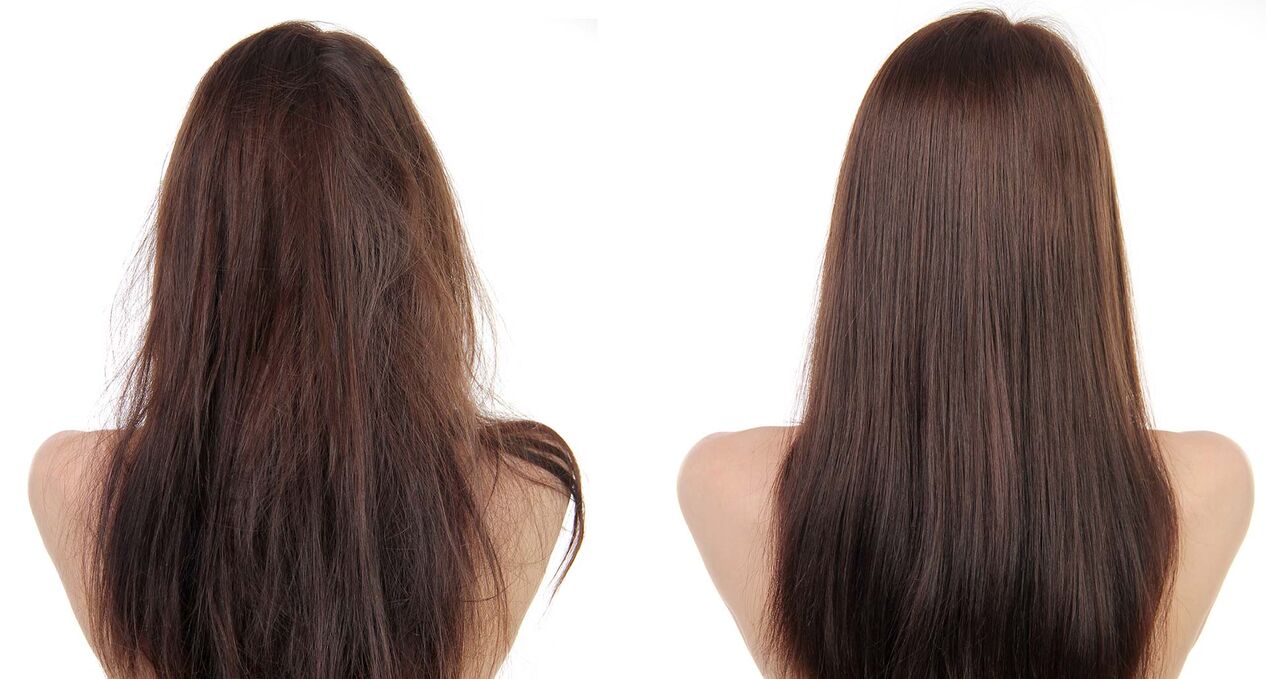 Hair restoration